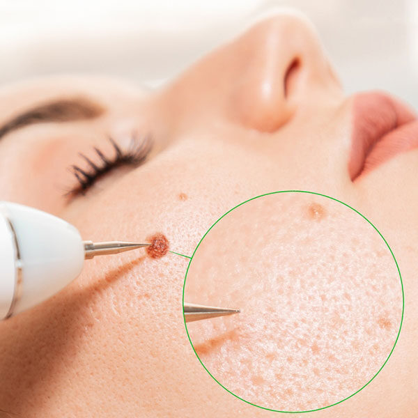 Usuwanie zmian skórnych